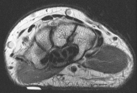 Figure 1 for case trapezial tubercle fracture ( RID2193 )